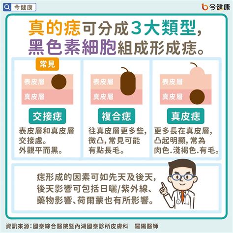 為什麼會長痣|是痣？還是皮膚癌？皮膚科醫師教你揪出「假的痣」，。